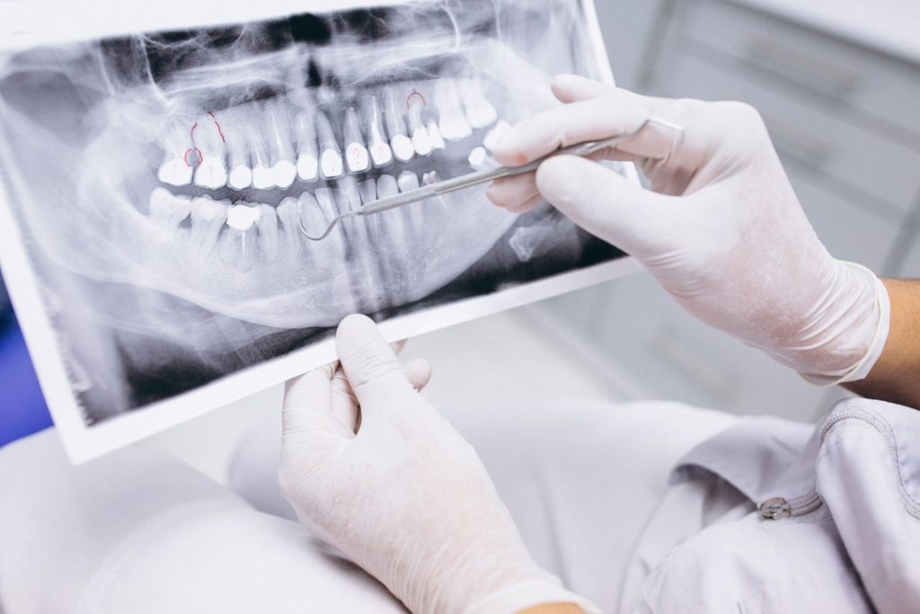 Leczenie kanałowe zębów jest często wykonywanym zabiegiem stomatologicznym